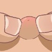 �Ҽ�������6(Acne Survival)